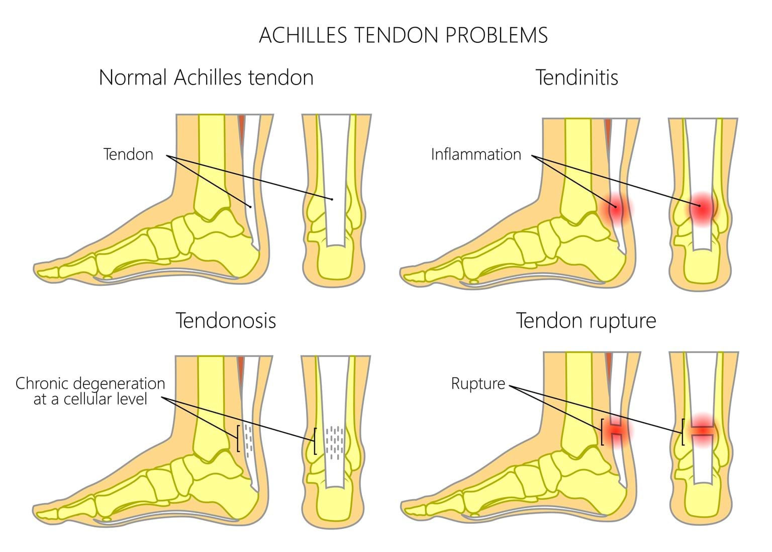 Foot Injury Physiotherapy | Territory Sportsmedicine